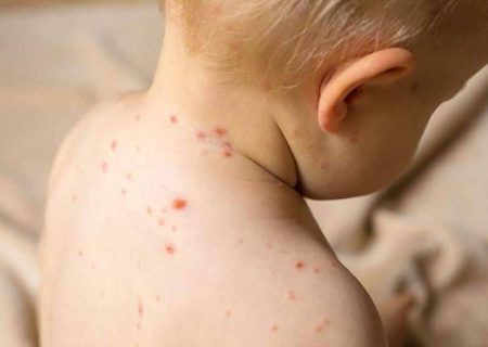 آغاز طرح واکسیناسیون تکمیلی سرخک ،سرخجه و اوریون در سیریک